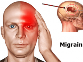 Nguyên nhân gây bệnh đau nửa đầu Migraine là gì?